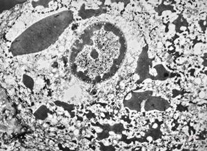 F, 11y. | ichthyosis hystrix type Curth-Macklin